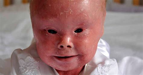 Wichitan with rare skin condition, global inspiration, dies at 21